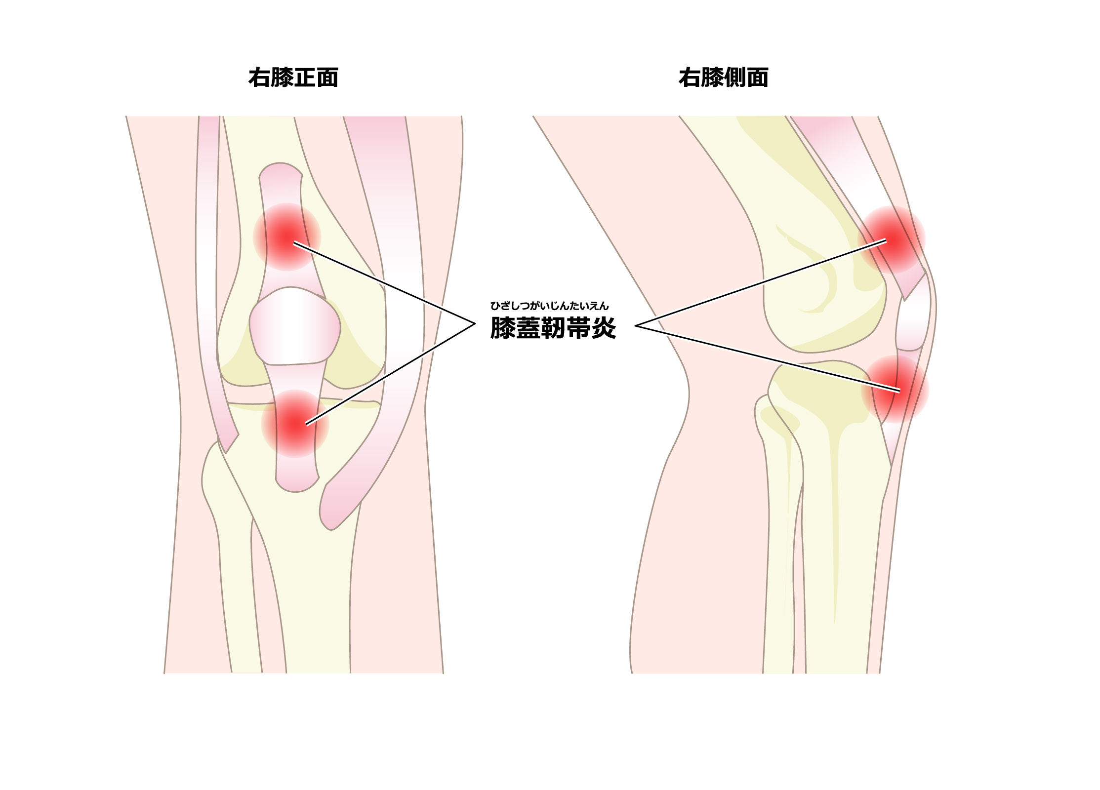 ジャンパー膝(膝蓋靭帯炎)施術写真