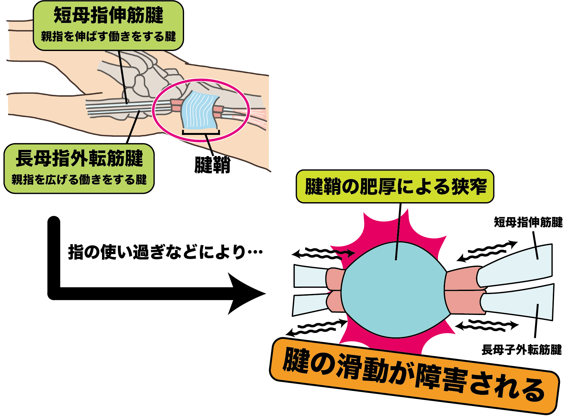 産後の腱鞘炎施術写真