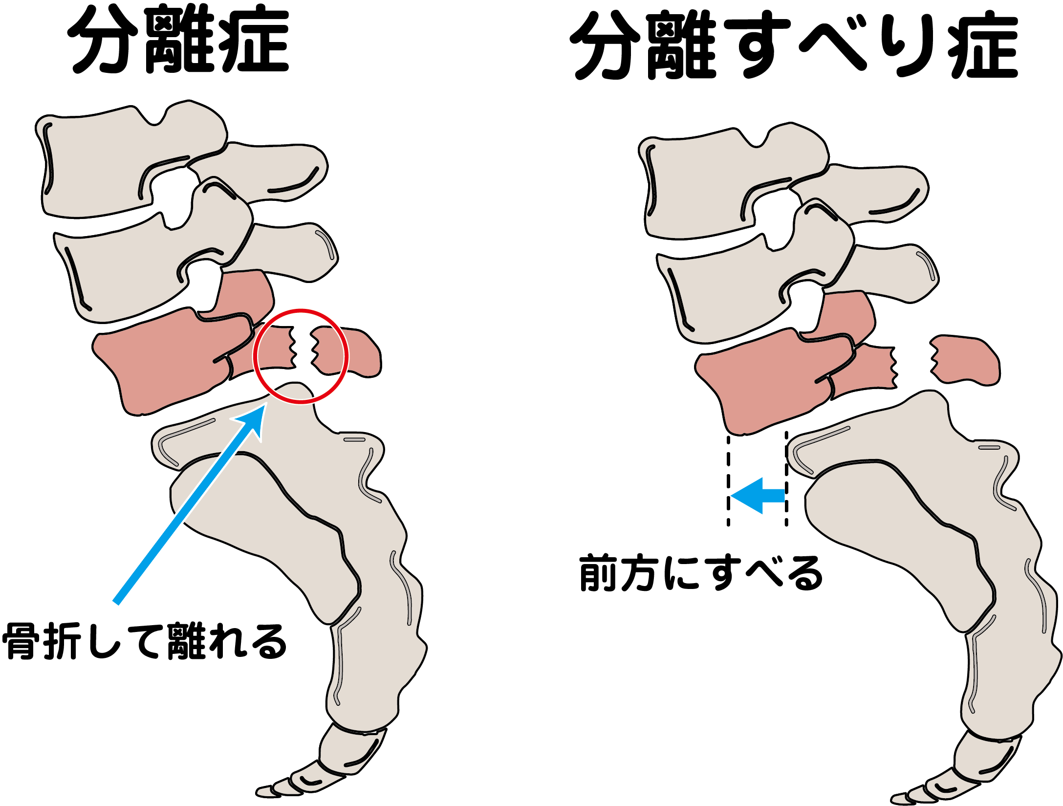腰椎分離症イラスト