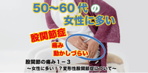 股関節の痛み１−３ 〜女性に多い股関節の症状！？変形性股関節症について〜