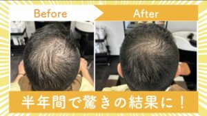 育毛革命！！！